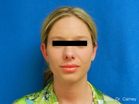 Virginia Beach Otoplasty Earlobe Repair 1223 - After Image 2