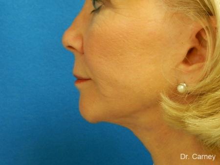 Virginia Beach Laser Skin Resurfacing - Face 1260 - After Image 3