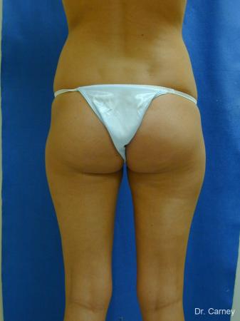 Virginia Beach Liposuction 1277 - After Image 3