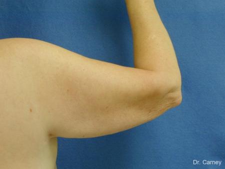 Virginia Beach Brachioplasty 1144 - After Image 2