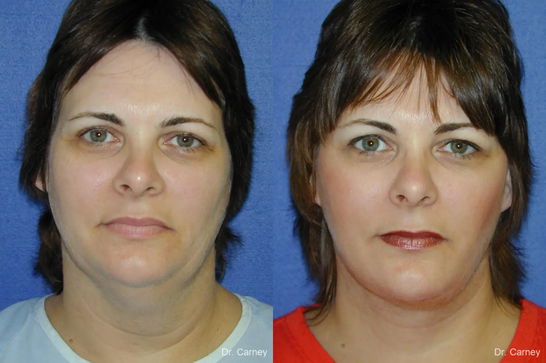 Virginia Beach Neck Lift 1269 - Before and After 3