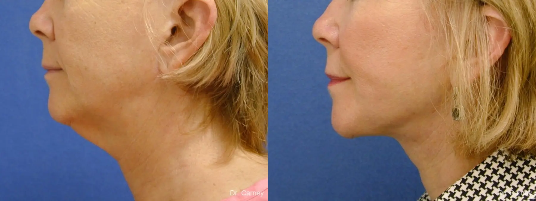 Virginia Beach Neck Lift 1264 - Before and After