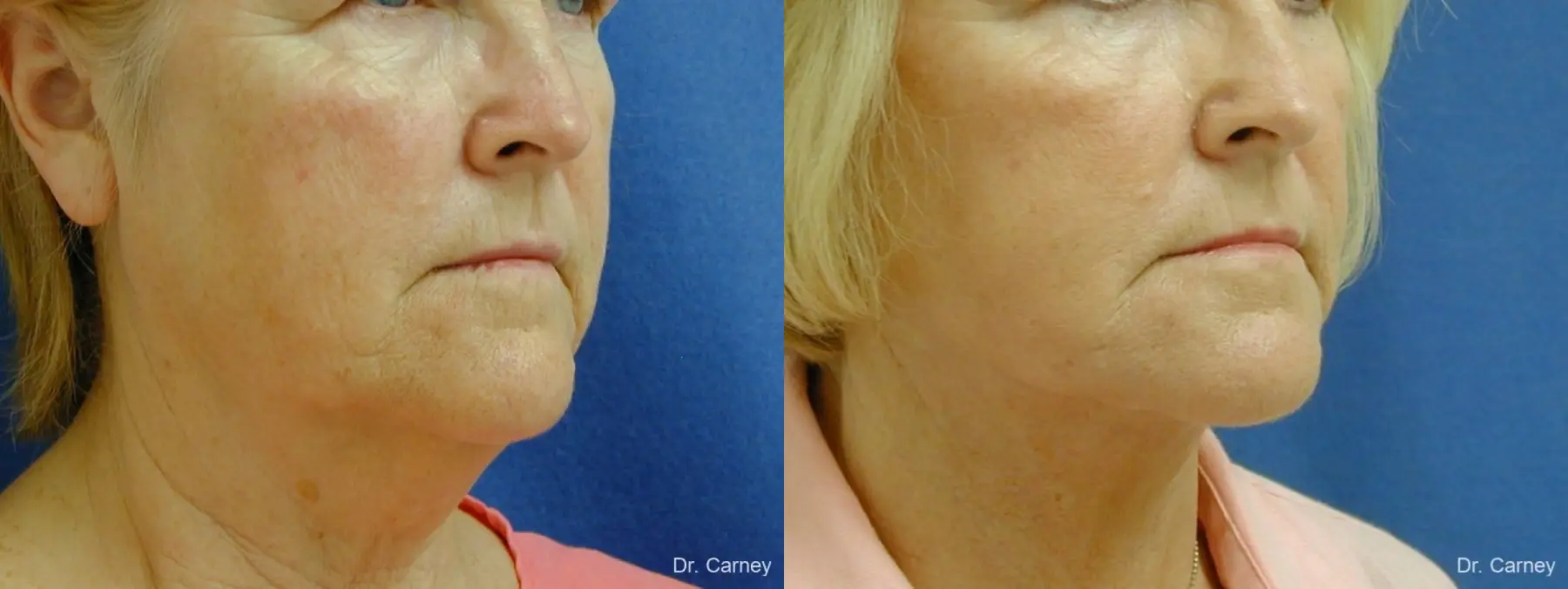Virginia Beach Neck Lift 1207 - Before and After