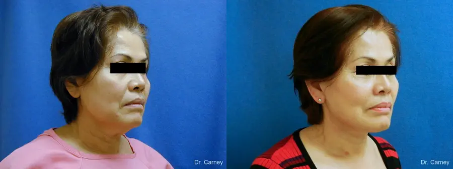 Virginia Beach Neck Lift 1268 - Before and After 2