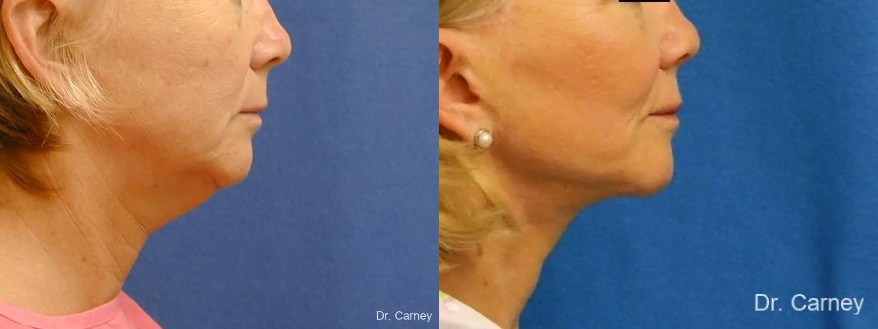 Virginia Beach Neck Lift 1264 - Before and After 2