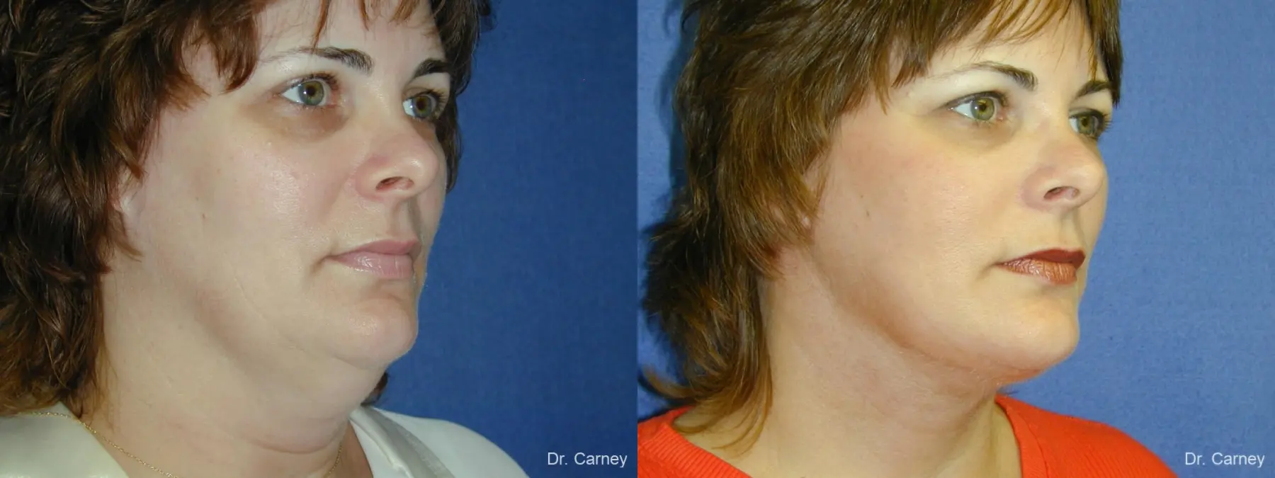 Virginia Beach Neck Lift 1269 - Before and After 2
