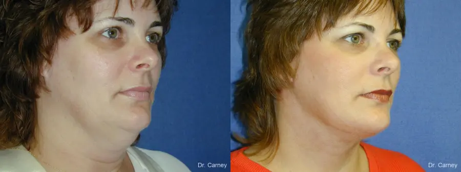 Virginia Beach Neck Lift 1269 - Before and After 2