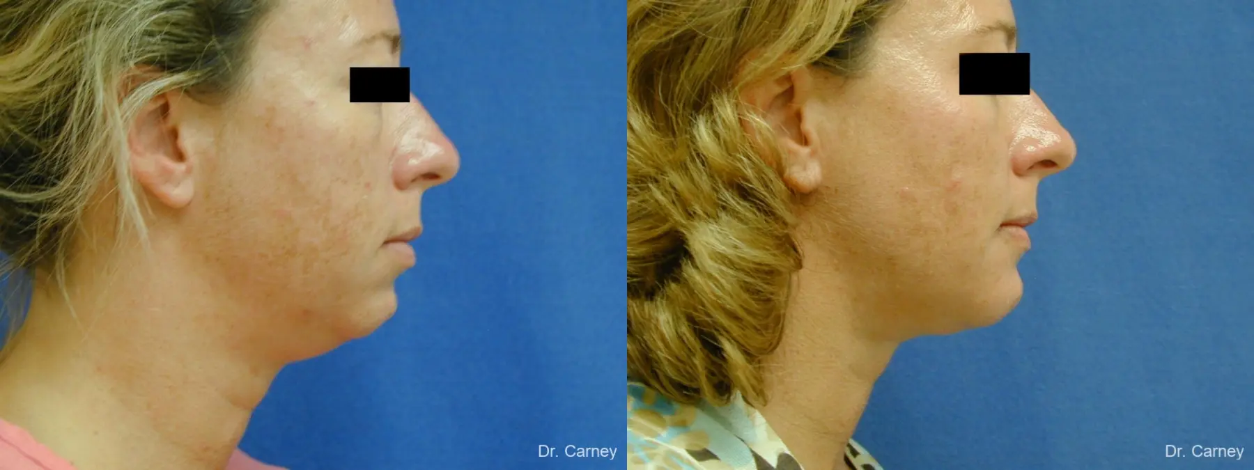 Virginia Beach Neck Lift 1267 - Before and After