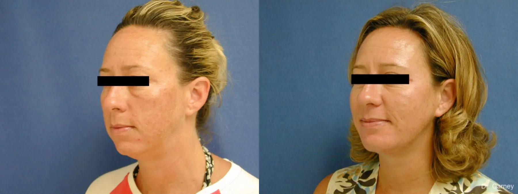 Virginia Beach Neck Lift 1267 - Before and After 2