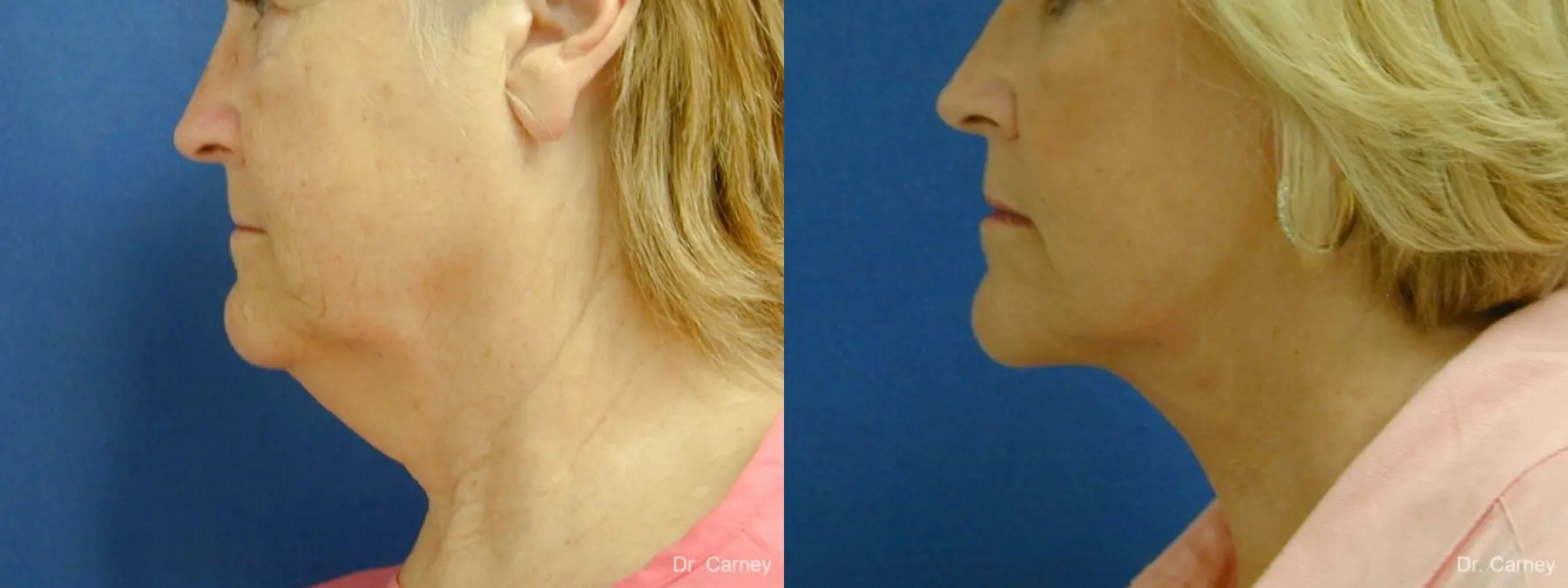 Virginia Beach Neck Lift 1207 - Before and After 3