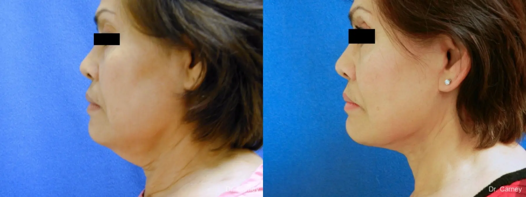 Virginia Beach Neck Lift 1268 - Before and After 3