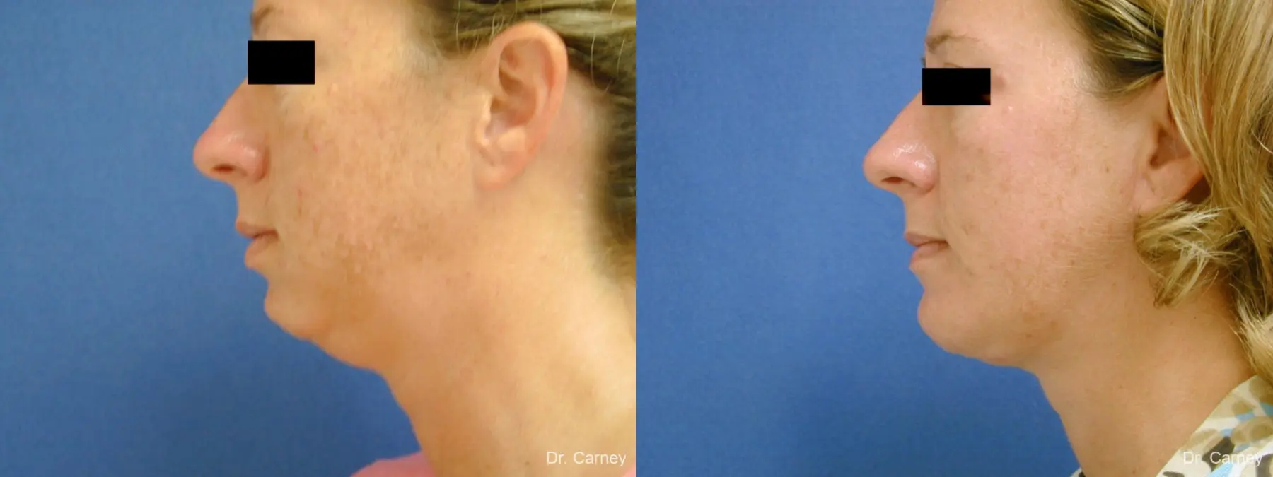 Virginia Beach Neck Lift 1267 - Before and After 4
