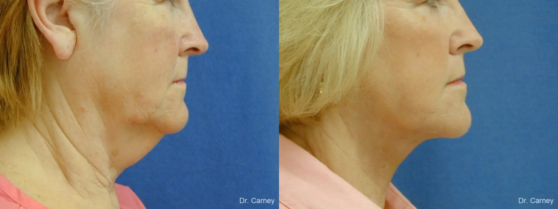 Virginia Beach Neck Lift 1207 - Before and After 2
