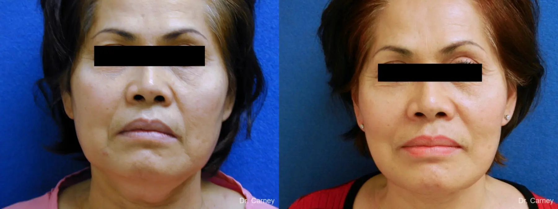 Virginia Beach Neck Lift 1268 - Before and After