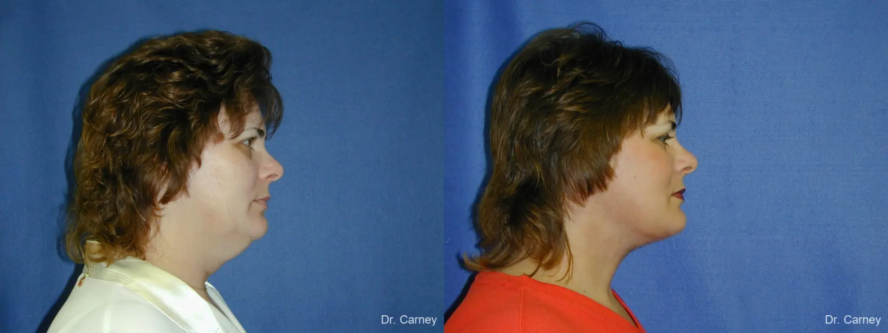 Virginia Beach Neck Lift 1269 - Before and After