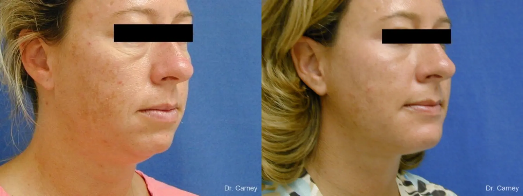 Virginia Beach Neck Lift 1267 - Before and After 3
