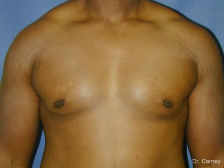 Virginia Beach Gynecomastia 1226 - After Image 1