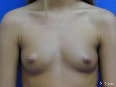Virginia Beach Breast Augmentation 1082 - Before and After Image 3