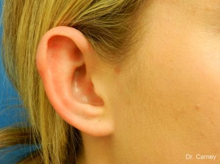 Virginia Beach Otoplasty Earlobe Repair 1223 - After Image 4