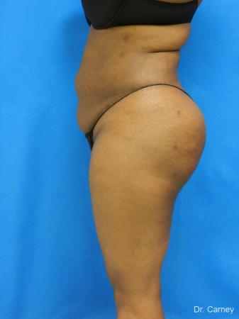 Brazilian Butt Lift: Patient 4 - After Image 1