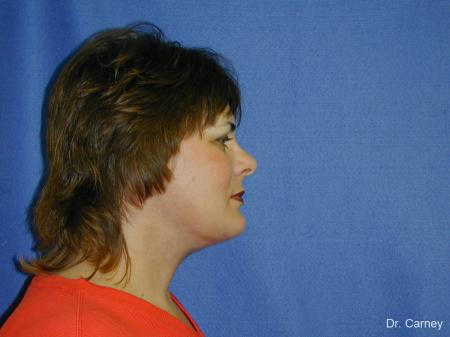 Virginia Beach Facelift 1136 - After Image 2