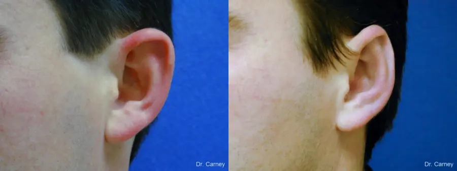 Virginia Beach Otoplasty Earlobe Repair 1237 - Before and After 3