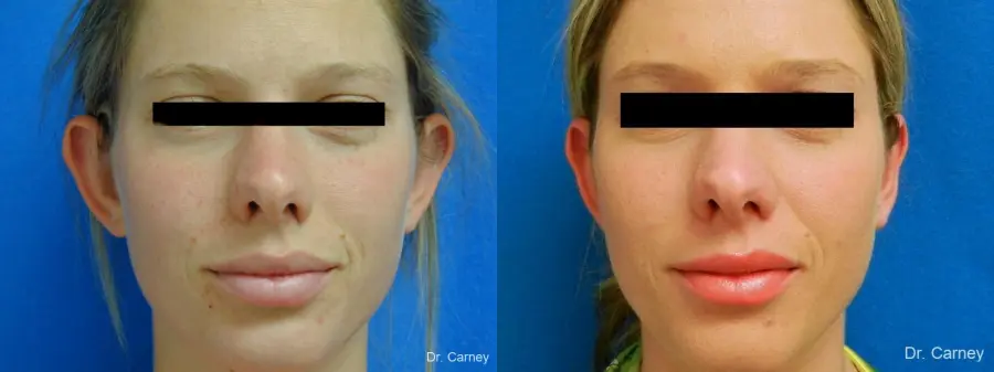 Virginia Beach Otoplasty Earlobe Repair 1223 - Before and After 3