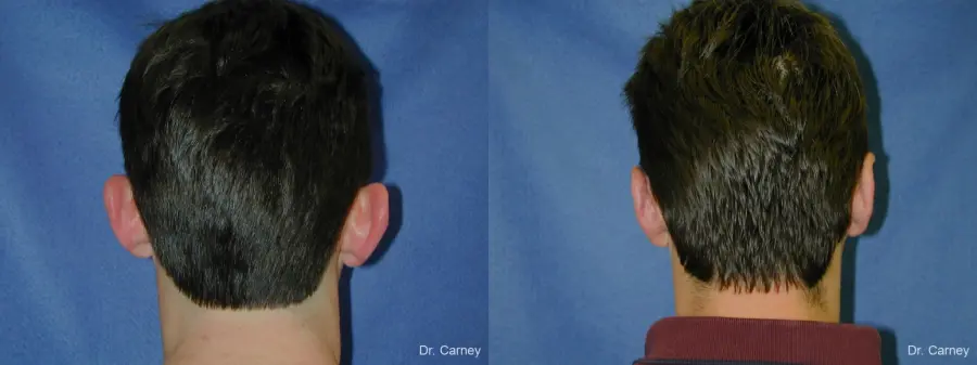 Virginia Beach Otoplasty Earlobe Repair 1237 - Before and After 1