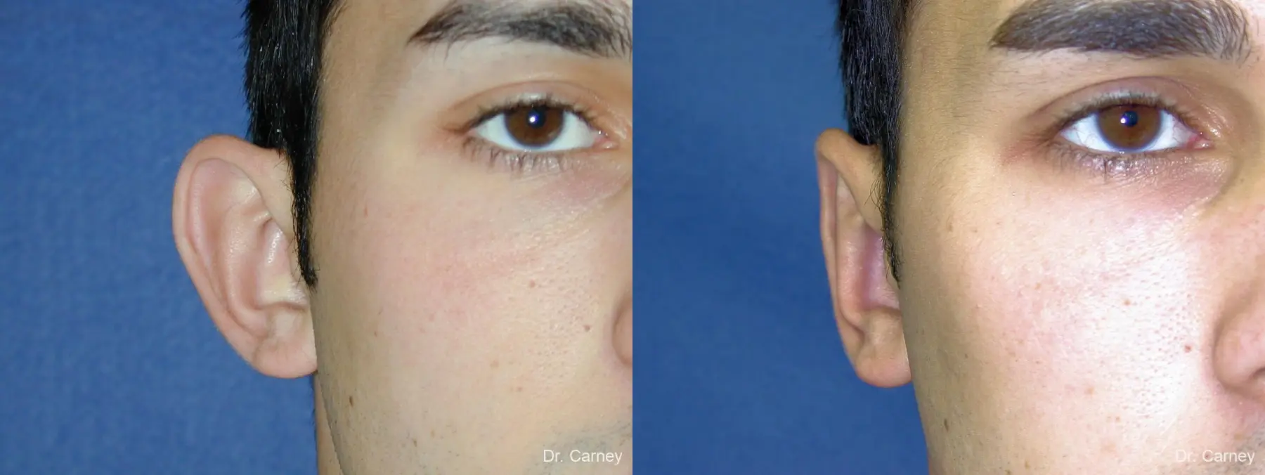 Virginia Beach Otoplasty Earlobe Repair 1222 - Before and After