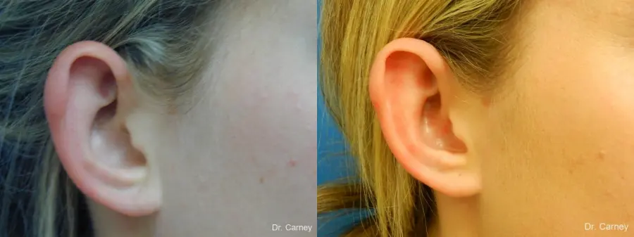 Virginia Beach Otoplasty Earlobe Repair 1223 - Before and After 4