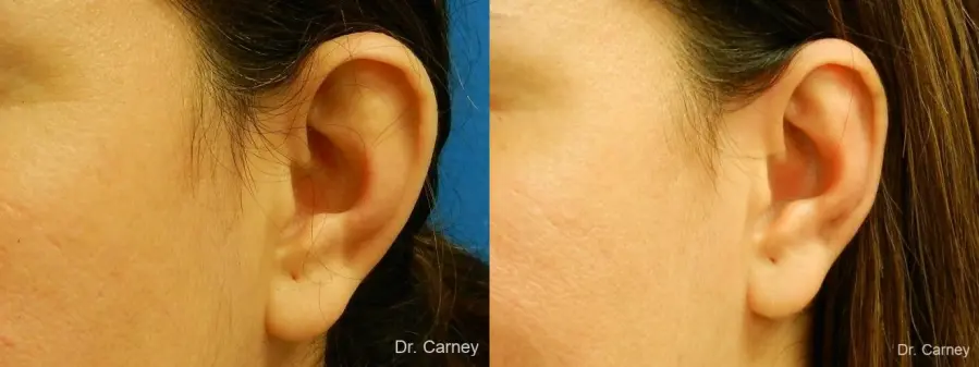 Virginia Beach Otoplasty Earlobe Repair 1225 - Before and After 2