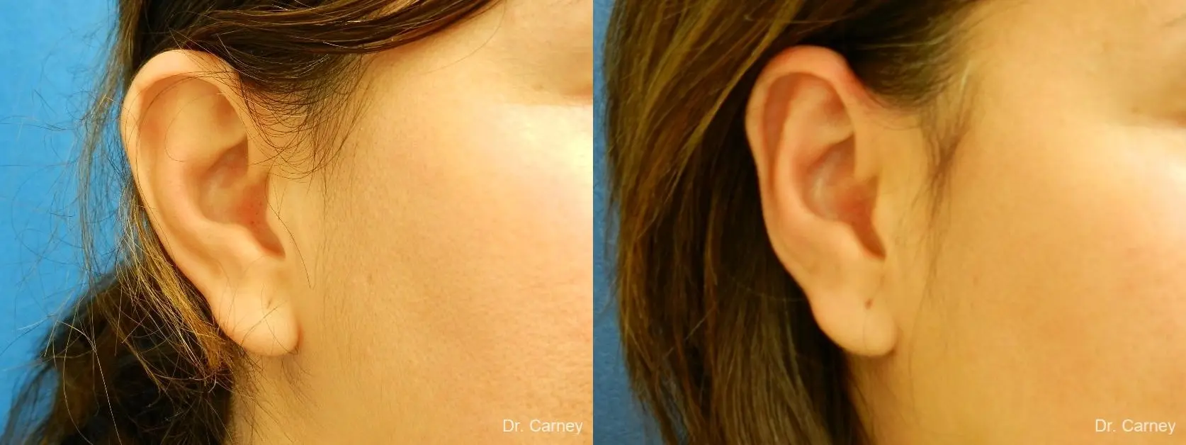 Virginia Beach Otoplasty Earlobe Repair 1225 - Before and After