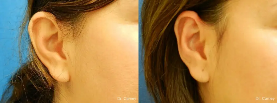 Virginia Beach Otoplasty Earlobe Repair 1225 - Before and After 1