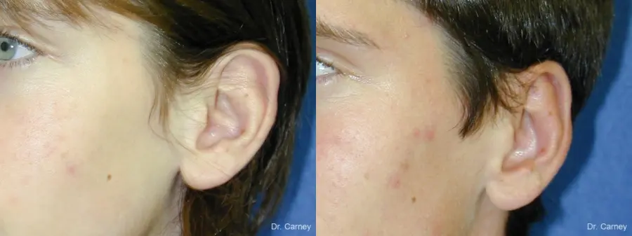 Virginia Beach Otoplasty Earlobe Repair 1271 - Before and After 3