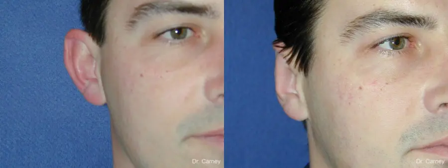 Virginia Beach Otoplasty Earlobe Repair 1237 - Before and After 4