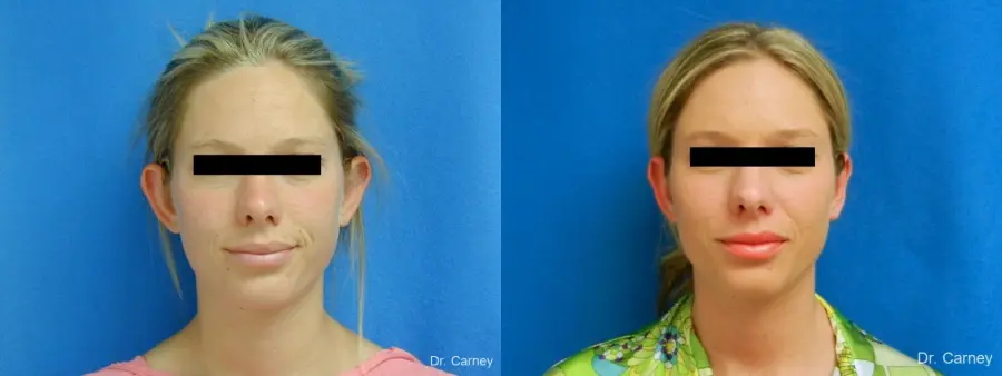 Virginia Beach Otoplasty Earlobe Repair 1223 - Before and After 2