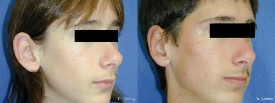 Virginia Beach Otoplasty Earlobe Repair 1271 - Before and After 2
