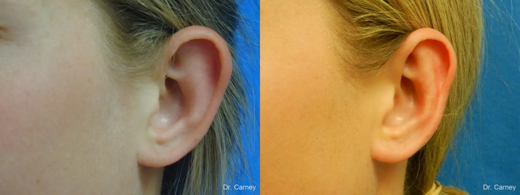 Virginia Beach Otoplasty Earlobe Repair 1223 - Before and After