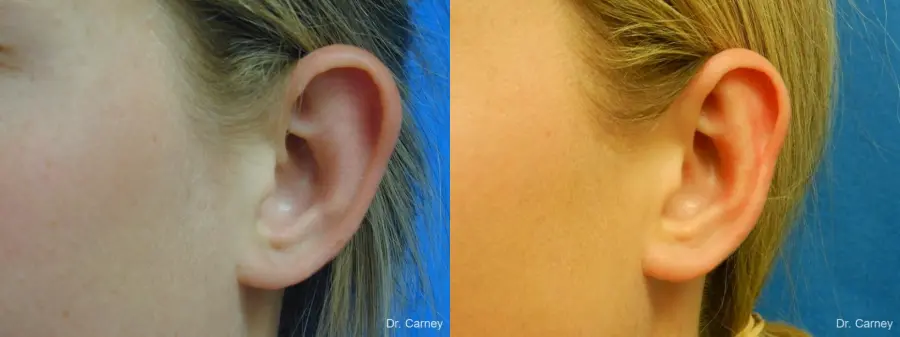 Virginia Beach Otoplasty Earlobe Repair 1223 - Before and After 1