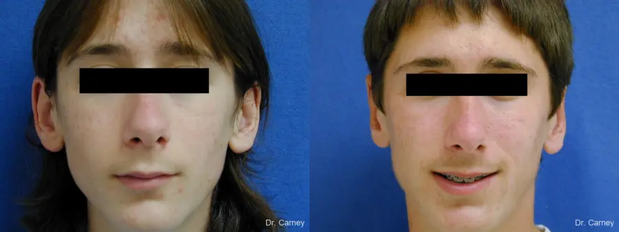 Virginia Beach Otoplasty Earlobe Repair 1271 - Before and After 1
