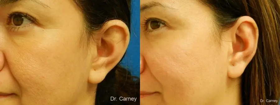 Virginia Beach Otoplasty Earlobe Repair 1225 - Before and After 4