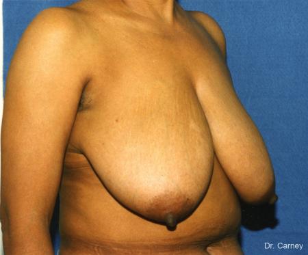 Virginia Beach Breast Reduction 1228. - Before and After Image 2