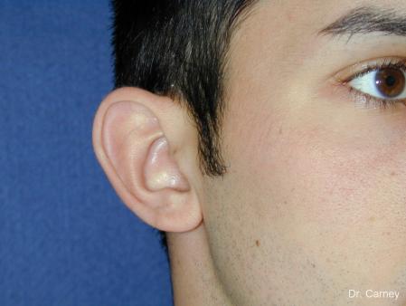 Virginia Beach Otoplasty Earlobe Repair 1222 - Before Image 3