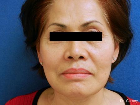 Virginia Beach Neck Lift 1268 - After Image 1