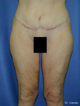 Virginia Beach Thigh Lift 1252 - After Image 1