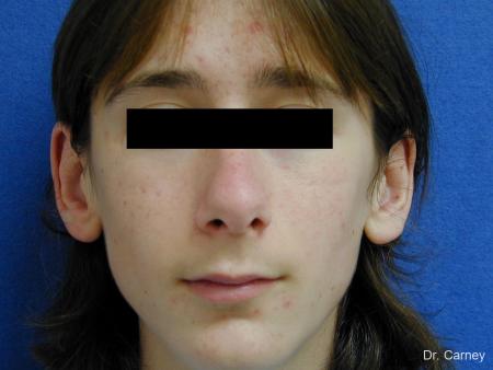 Virginia Beach Otoplasty Earlobe Repair 1271 - Before Image 1