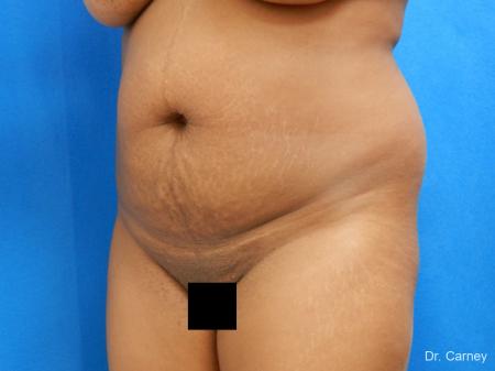Abdominoplasty: Patient 1 - Before Image 4