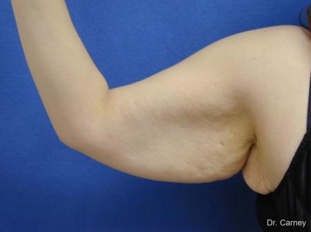 Virginia Beach Brachioplasty 1140 - Before Image 1