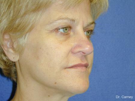 Virginia Beach Brow Lift 1345 - Before Image 1