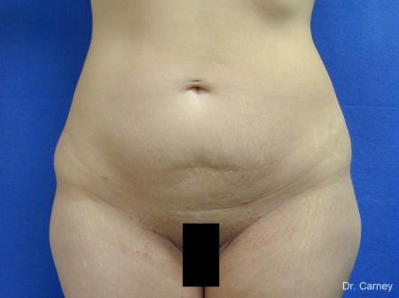 Tummy Tuck: Patient 1 - Before Image 1